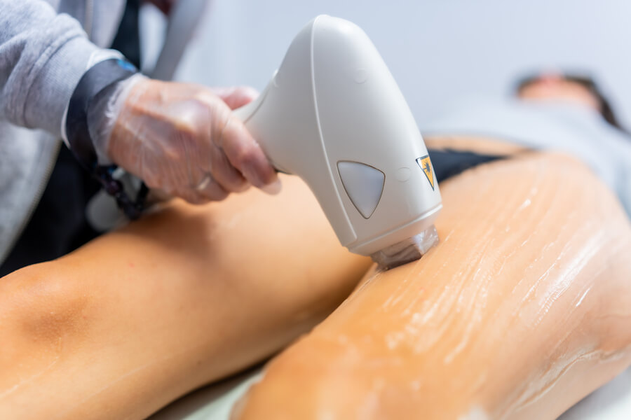 Beneficios de la depilación laser como funciona - Tratamiento estético en las piernas con dispositivo de láser o radiofrecuencia