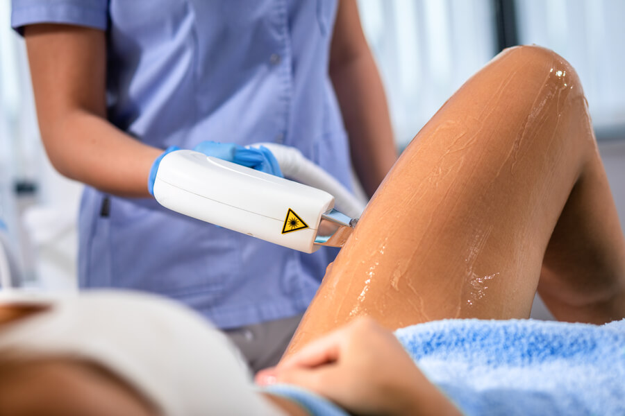 Beneficios de la depilación laser conclusión - Aplicación de láser en tratamiento estético para piernas