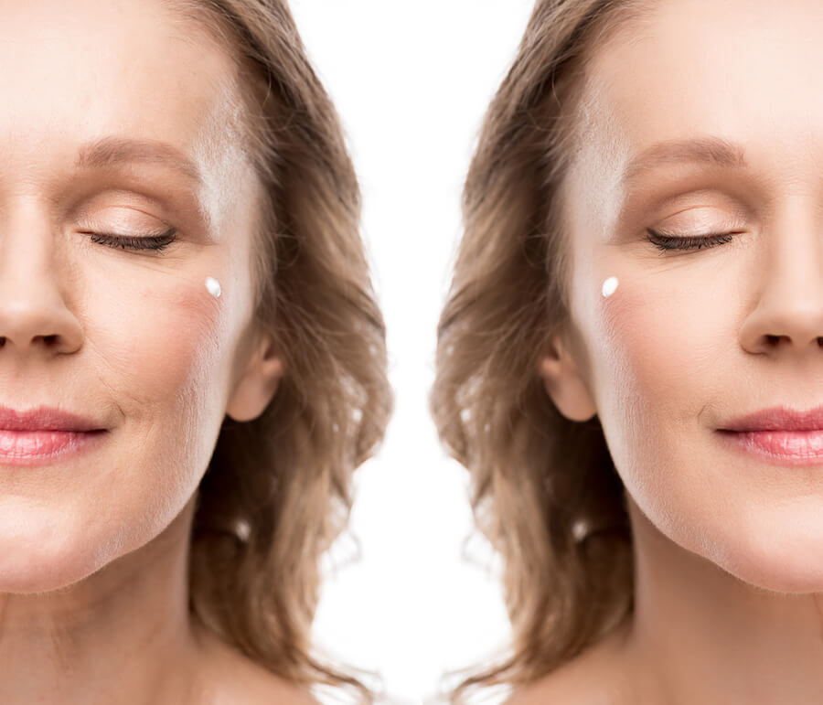 Bioestimulador sculptra comparativa - Comparación facial antes y después de tratamiento cosmético
