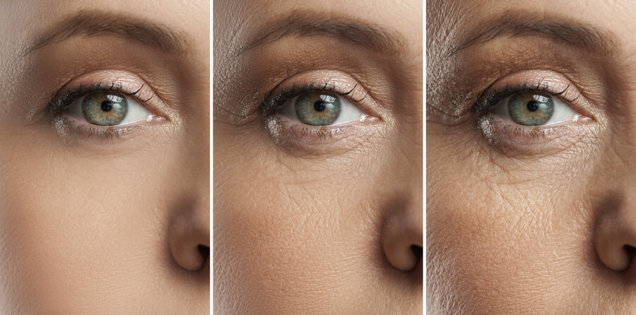 Harmonyca que es comparación - Evolución del envejecimiento en la piel alrededor de los ojos