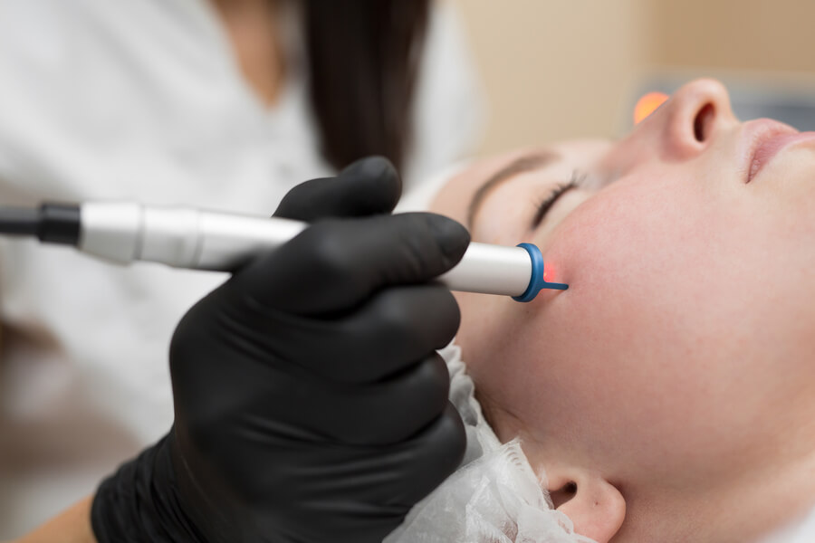 Láser CO2 Fraccionado Cómo Funciona que es - Tratamiento facial con dispositivo estético en la mejilla
