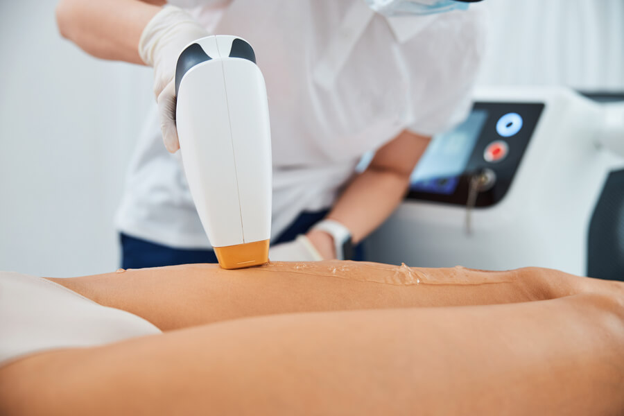 Depilación con láser bikini mitos - Profesional realizando depilación láser en abdomen de paciente con dispositivo especializado