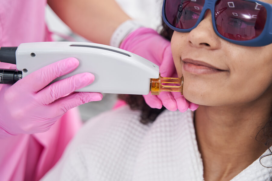 Láser co2 fraccionado para manchas efectos - Depilación láser facial en la zona de las mejillas con protección ocular.