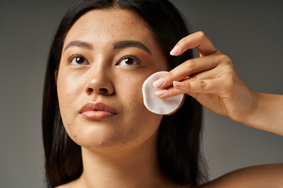 Láser para cicatrices de acne - Mujer limpiando su rostro con un algodón