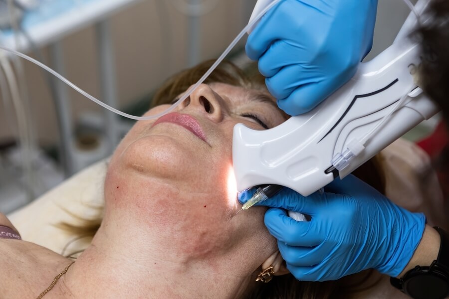 Láser CO2 Medellín que es - Tratamiento láser facial.
