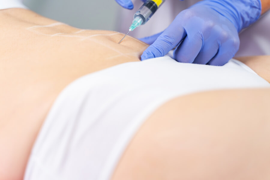 Carboxiterapia en abdomen: cómo actúa y qué resultados esperar