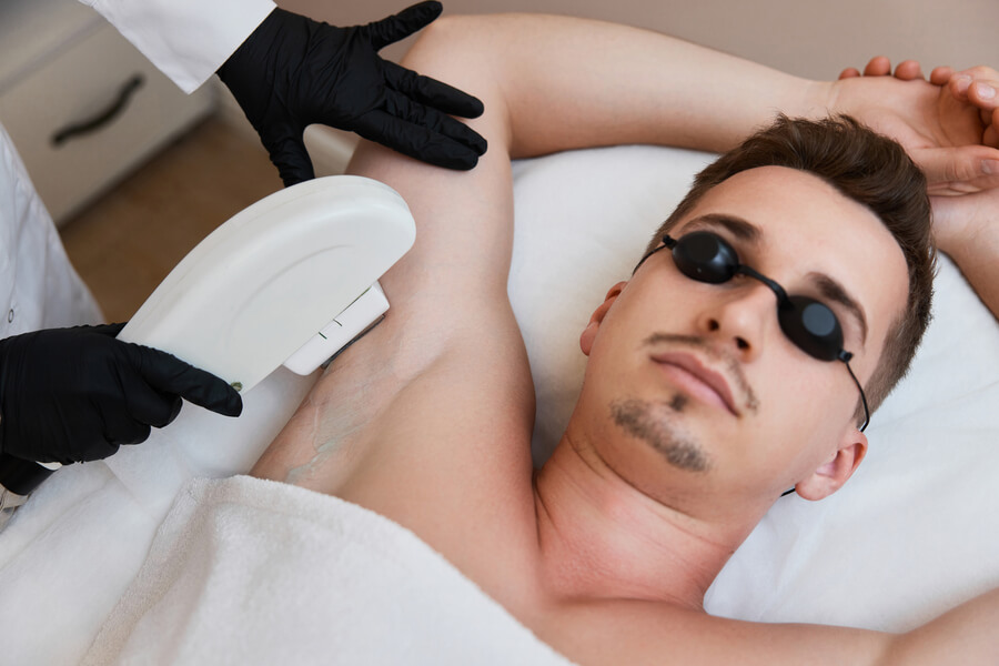 Depilación láser masculina en la zona de las axilas.