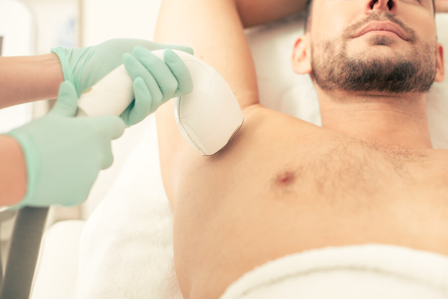 Depilación láser masculina en la zona de las axilas.