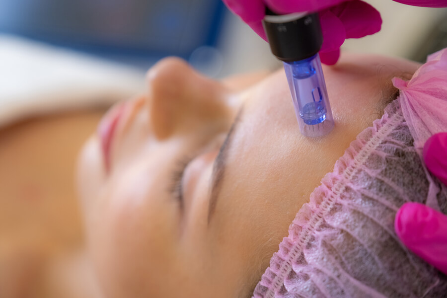Dermapen antes y después: qué cambia y en cuánto tiempo