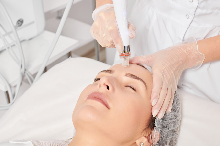 Dermapen: beneficios reales para tu piel y cuándo aplicarlo
