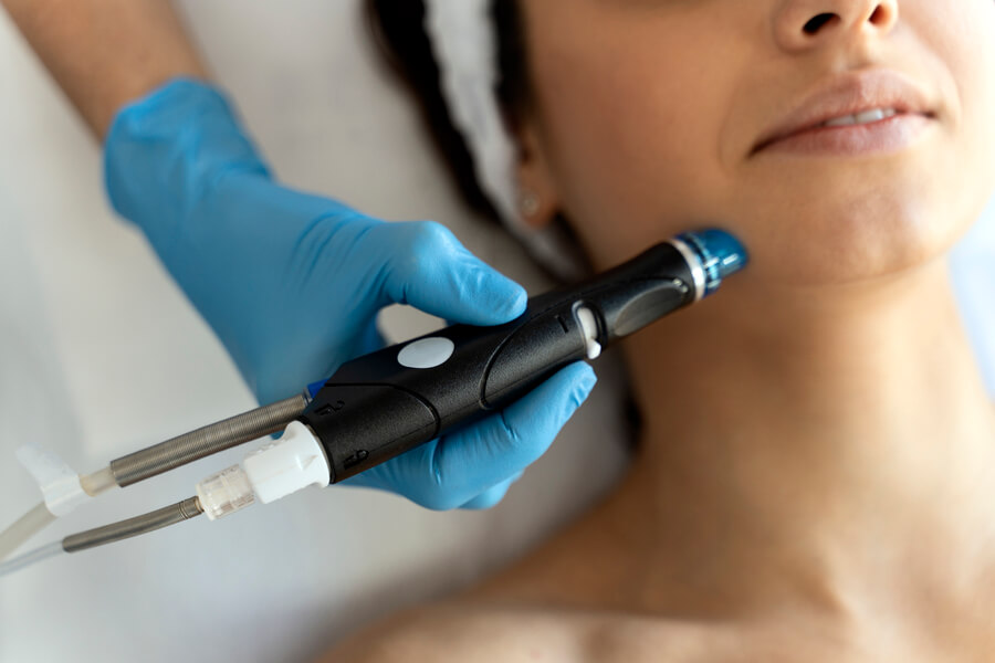 Dermapen facial: qué es, zonas que trata y qué esperar