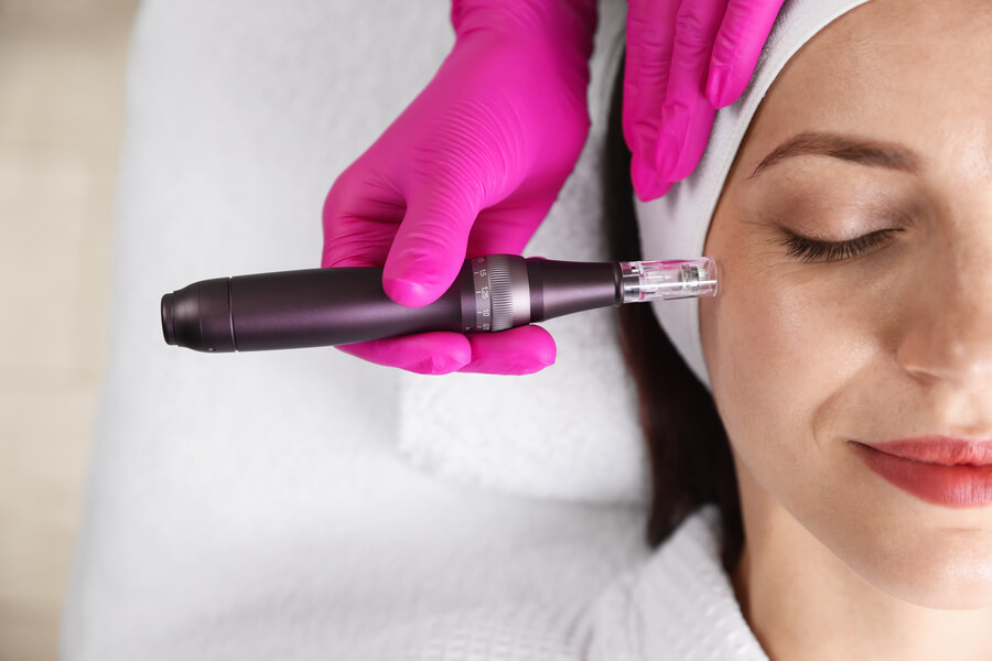 Dermapen profesional: por qué importa quién lo aplica